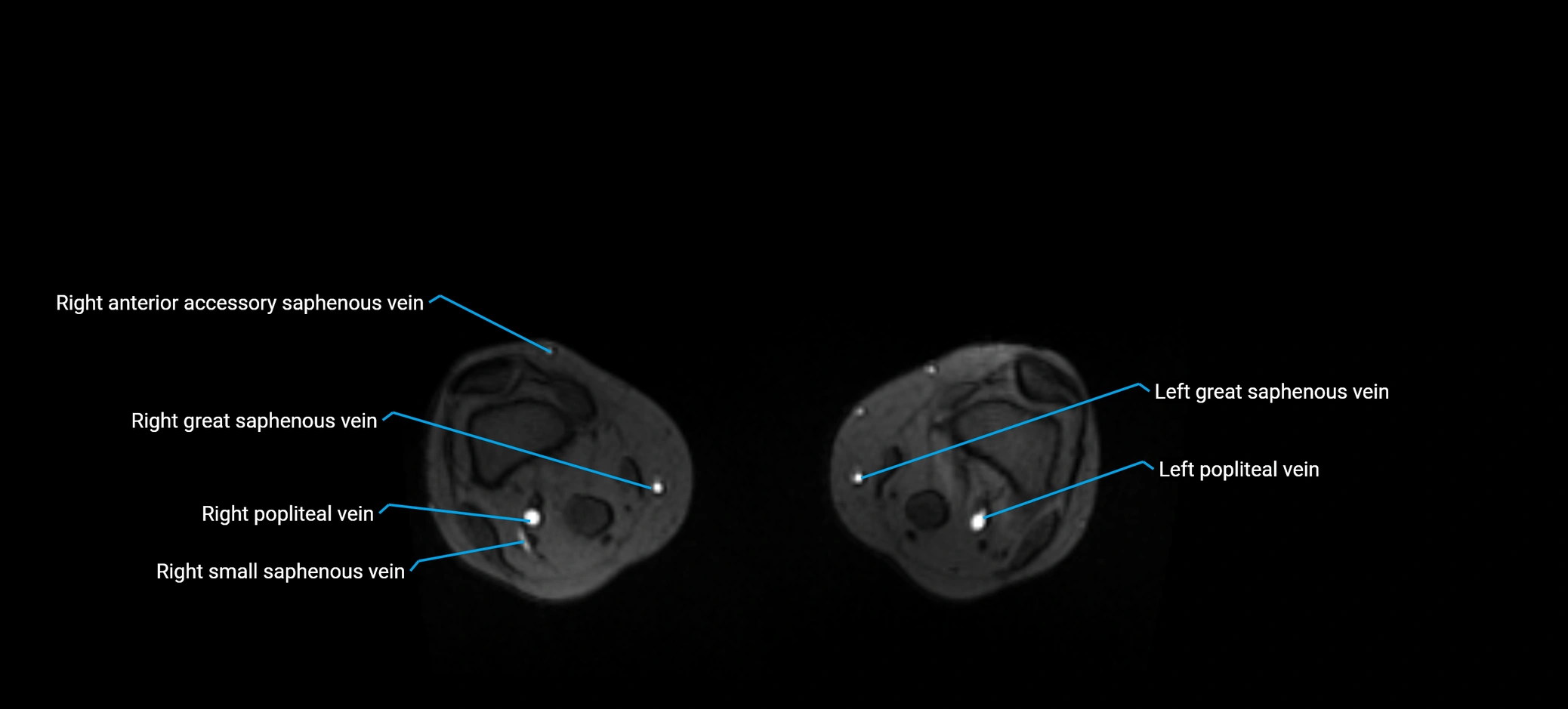 MRV abdomen pelvis & lower limb axial cross sectional anatomy labelled MRI image 353.webp